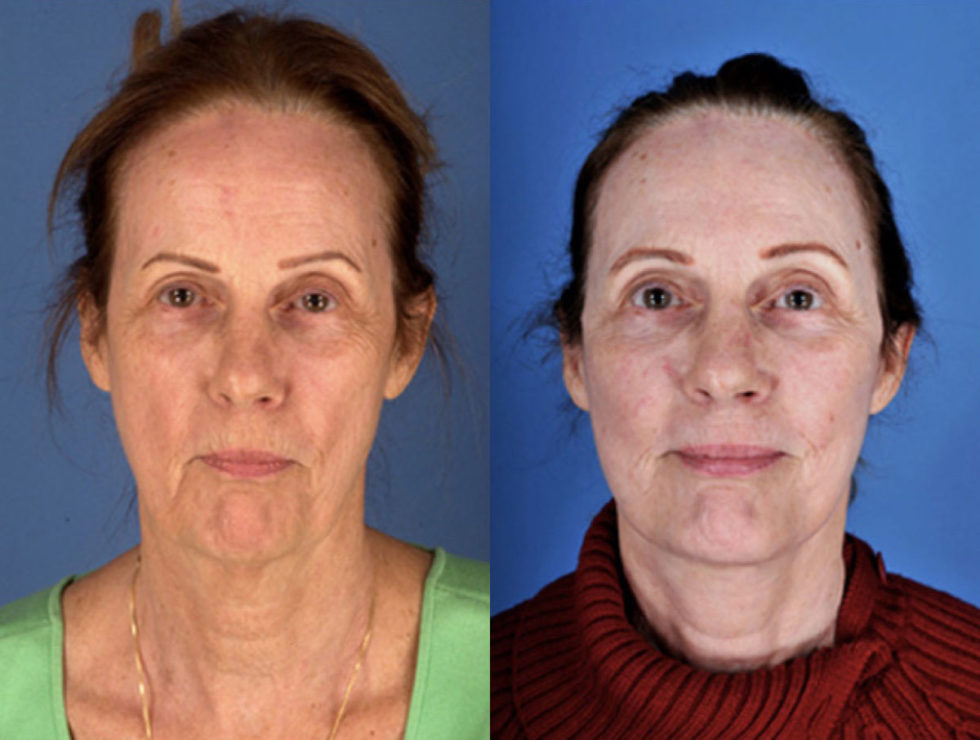 Neck Lift New York City Face Surgery Great Neck 5714